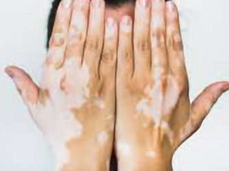 New Vitiligo Research Study Results