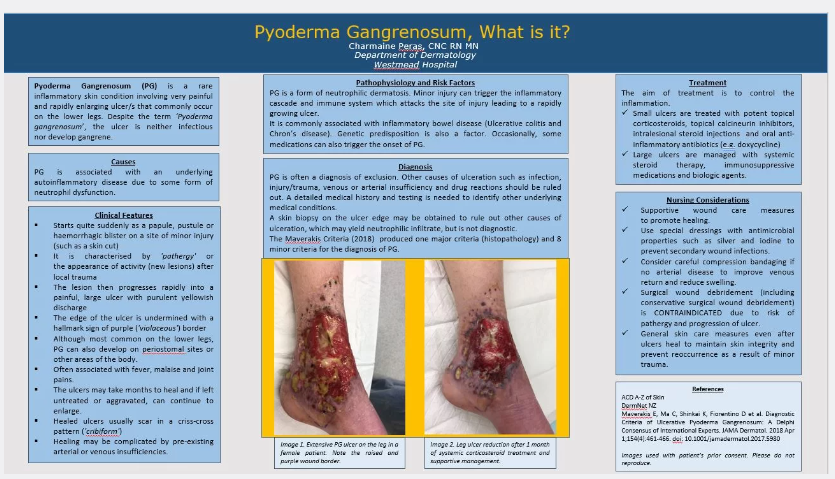 Pyoderma Gangrenosum – by Charmaine Peras