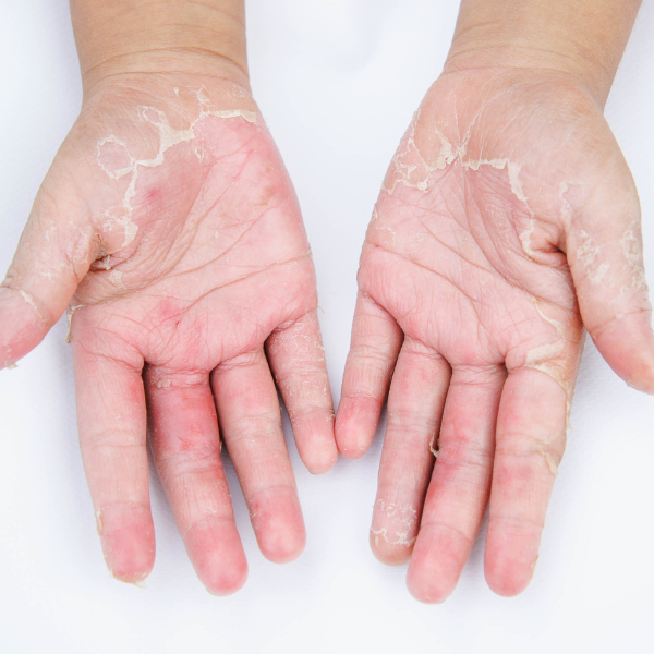 Clinical Treatment Series – Contact Dermatitis